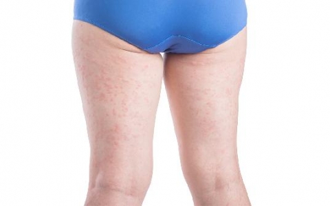 大腿肌肉拉伤恢复的时候有什么症状