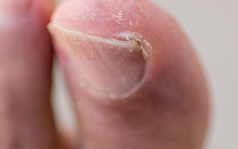 指甲甲沟炎化脓怎么处理好得快些