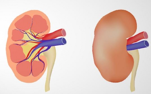 与肾小管梗阻有关的肾囊肿为
