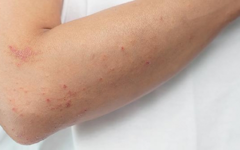 口底蜂窝织炎的症状是什么?