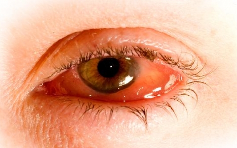 眼睑下垂的手术方法有哪些