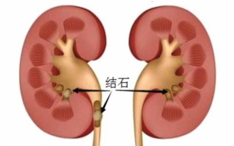 排肾结石的药哪样最好